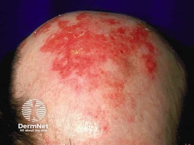 Воспалительная реакция при нанесении крема с фторурацилом на очаги актинического кератоза