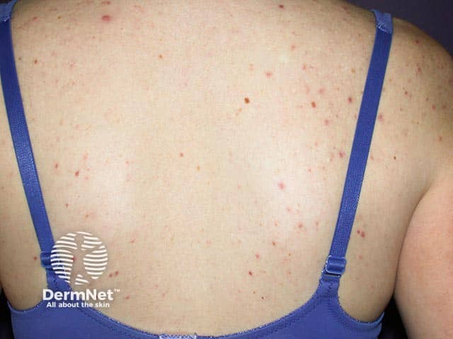Перифолликулярный эластолиз на фоне активных элементов акне на спине
