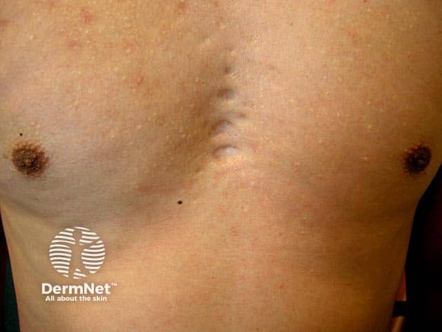Широкие атрофические рубцы после перенесенного акне в престернальной области