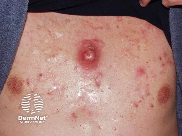Акне кожи груди с папулами, пустулами, рубцами и крупной кистой