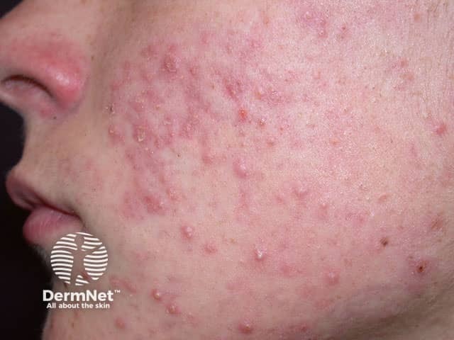 Вульгарные угри (Acne vulgaris): воспалительные папуло-пустулезные элементы