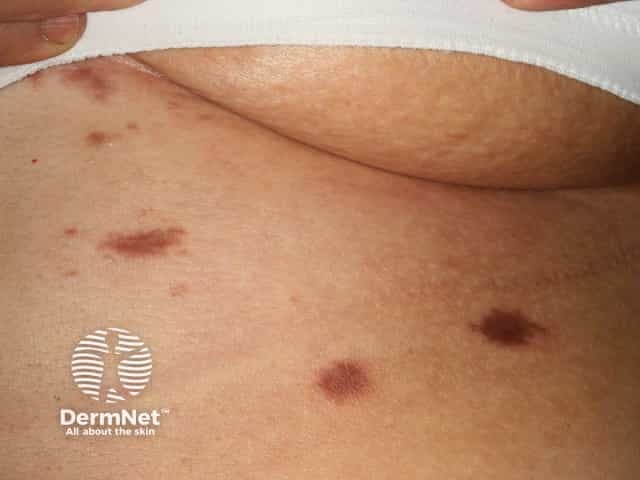 Приобретенная дермальная пятнистая гиперпигментация