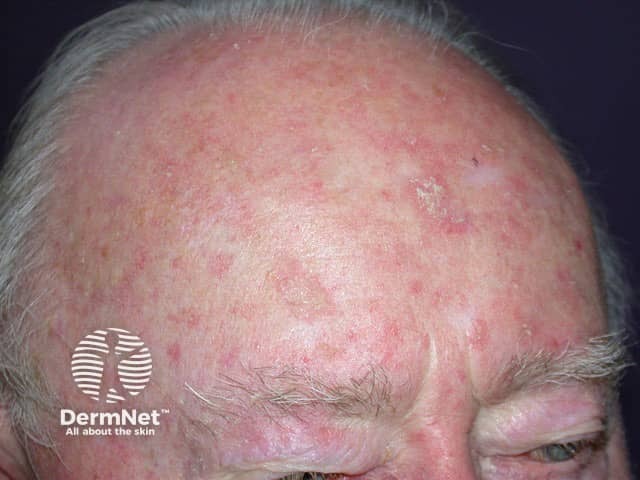 Полевая канкризация в области лба с множественными поверхностными очагами актинического кератоза