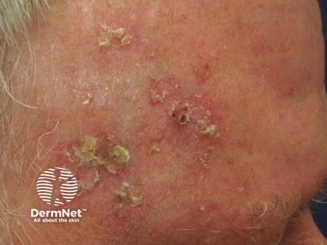 Гиперкератотические бляшки актинического кератоза на коже лба