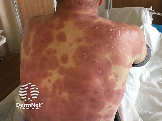 Распространенные сливные очаги острого фебрильного нейтрофильного дерматоза на туловище