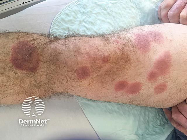 Бляшки при остром фебрильном нейтрофильном дерматозе на нижних конечностях