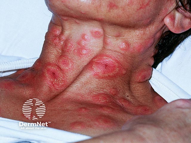 Кольцевидные высыпания на шее при остром фебрильном нейтрофильном дерматозе: обратите внимание на псевдовезикуляцию по периферии