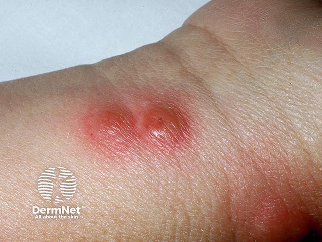 Острый фебрильный нейтрофильный дерматоз в области лучезапястного сустава