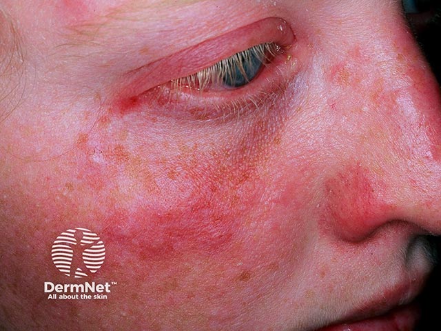 Отечные бляшки на щеке при остром фебрильном нейтрофильном дерматозе; обратите внимание на синдром «красного глаза» (инъекцию склер)