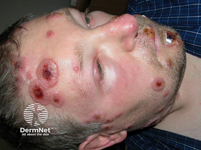 Тумидные геморрагические бляшки при остром фебрильном нейтрофильном дерматозе
