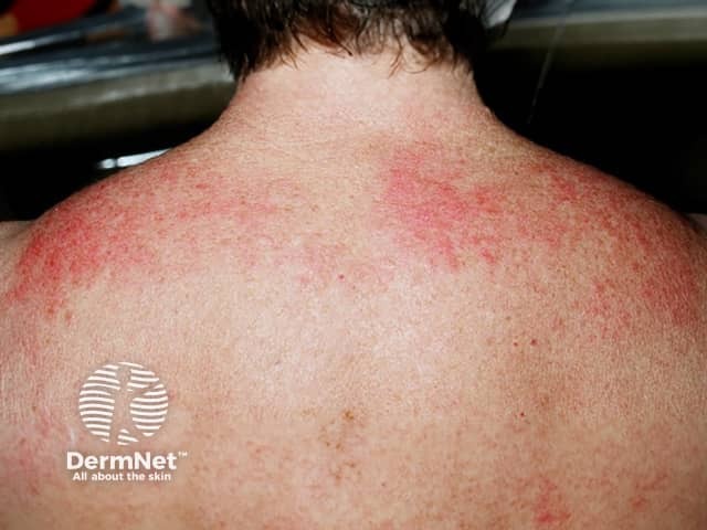 Симптом шали в области плечевого сустава