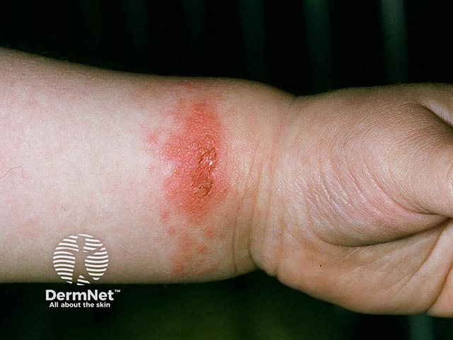 Аллергия на никель в области запястья от жесткого браслета