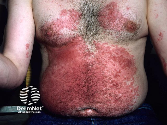 Аллергия на пыль палисандра с развитием дерматита кожи груди и живота