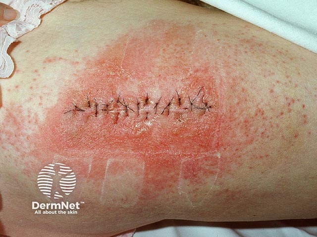 Буллезный контактный дерматит, вызванный нанесением сложной бензойной настойки (бальзама монахов) на послеоперационную рану