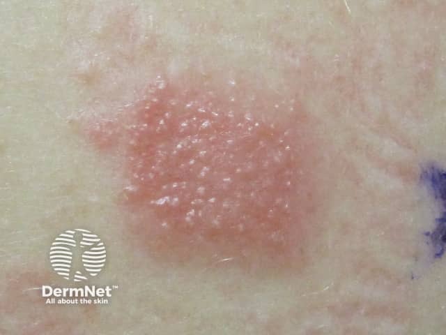 Положительная реакция патч-теста на смесь парабенов (paraben mix)