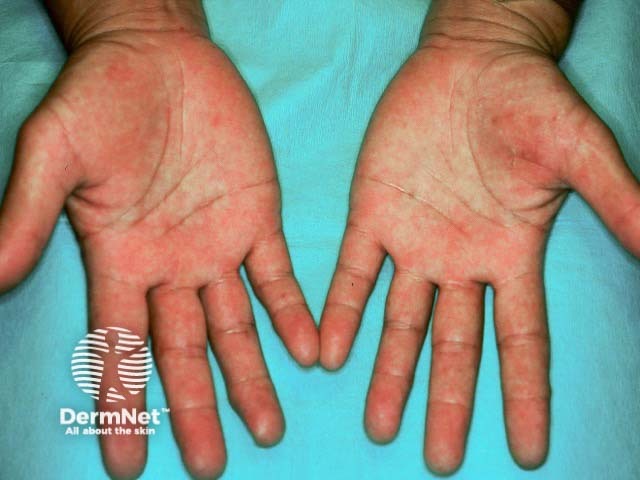 Аллергическая реакция 4-го типа на латекс, проявляющаяся ладонной экземой