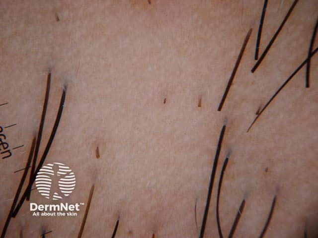 Дерматоскопическая картина у пациента с темным фототипом кожи: сетчатый рисунок по типу «пчелиных сот»; белые фолликулярные устья на фоне сетчатой пигментации