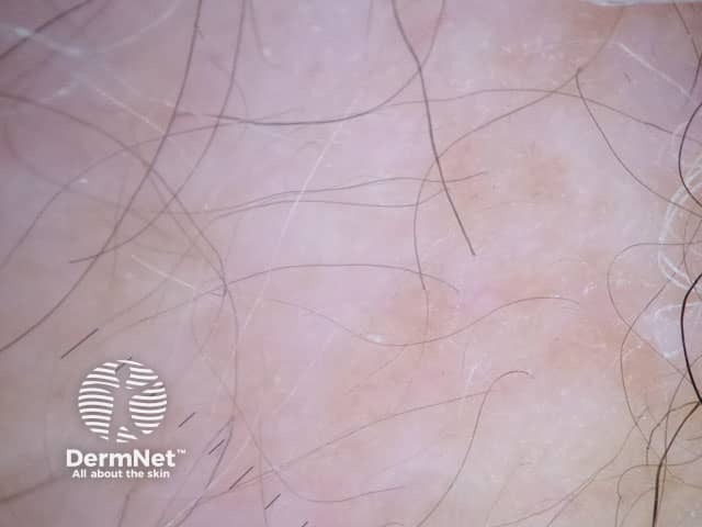 Дерматоскопическая картина волосистой части головы у пациентки с длительно существующей гнездной алопецией: белые бесструктурные зоны, соответствующие фиброзу