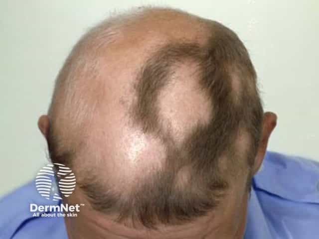 Гнездная алопеция