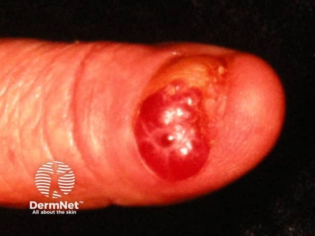 Беспигментная подногтевая меланома: образование красного цвета, исходящее из ногтевого валика и вызвавшее разрушение ногтевой пластины