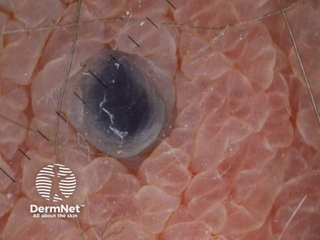 Дерматоскопия ангиокератомы Фордайса вульвы