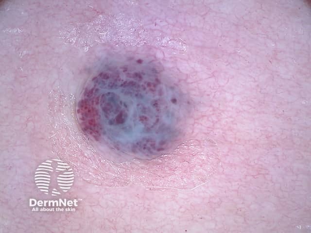 Дерматоскопия ангиокератомы Фордайса вульвы