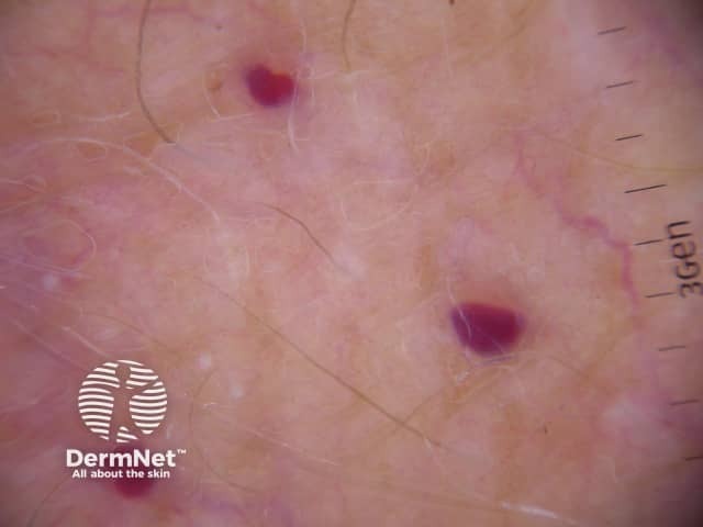 Дерматоскопия ангиокератомы Фордайса вульвы