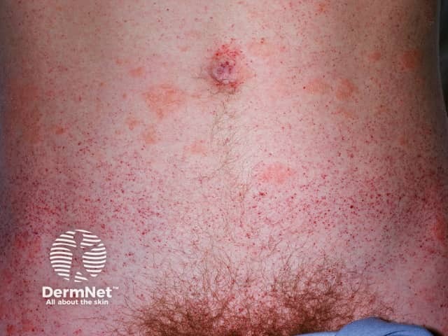 Ангиокератомы при болезни Фабри