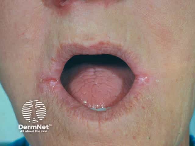 Ангулярный хейлит у пациента со съемными зубными протезами