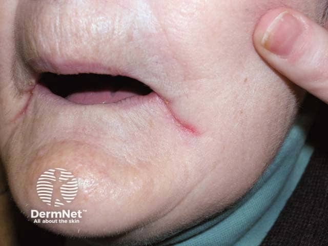 Пациентка с адентией: эритема и мокнутие в латеральной периоральной складке
