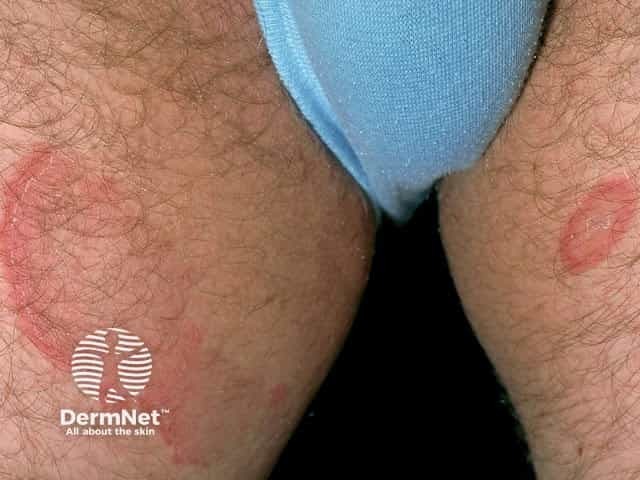 Центробежная кольцевидная эритема