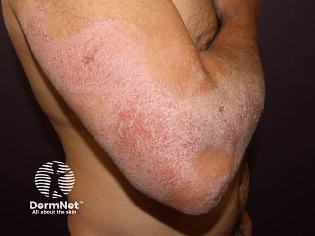 Сухая форма атопического дерматита с поражением разгибательных поверхностей