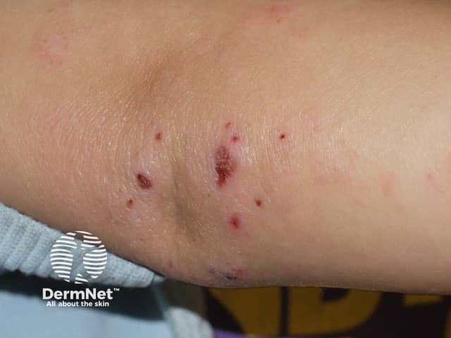 Экзема локтевого сустава с экскориациями