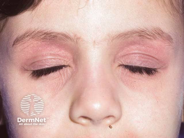 Двусторонняя эритема и лихенификация кожи век при атопической экземе