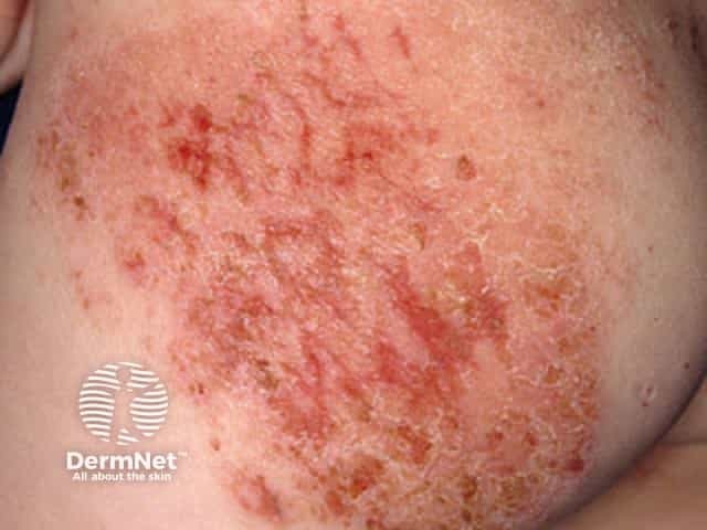 Атопический дерматит