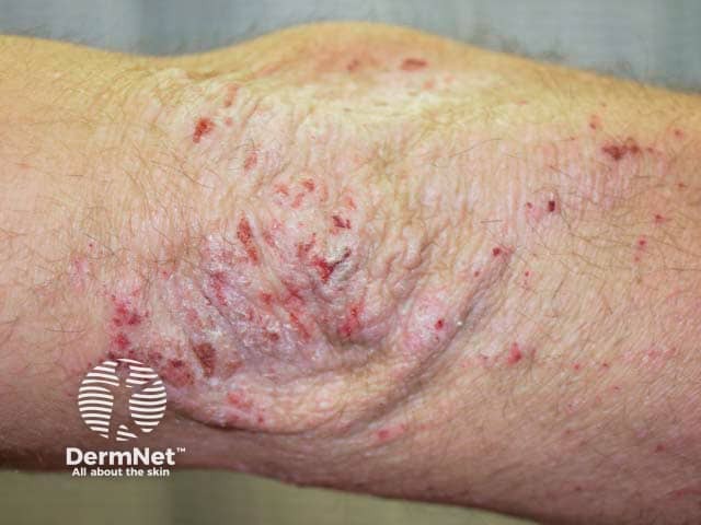 Хроническая экзема с лихенификацией и экскориациями на локте