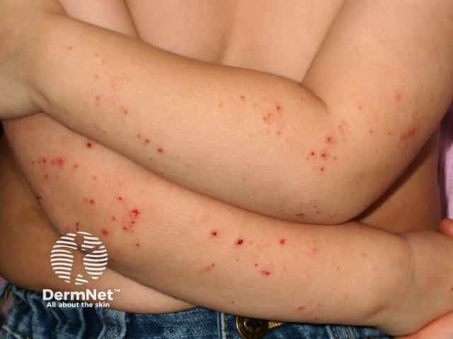 Зудящий атопический дерматит