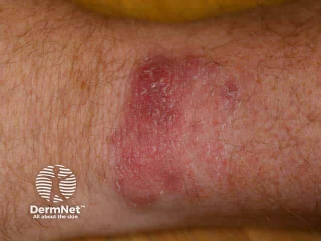 Бляшка на кисти, вызванная инфекцией Mycobacterium marinum
