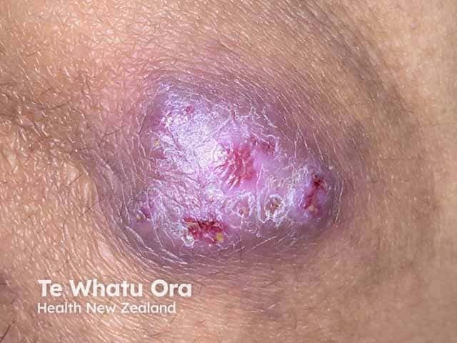Инфекция Mycobacterium marinum в области колена