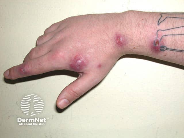 Инфекция Mycobacterium marinum со споротрихоидным распространением