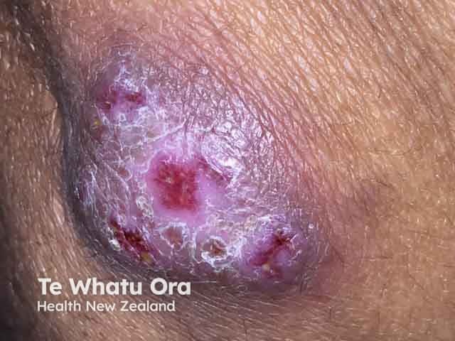 Инфекция Mycobacterium marinum в области колена