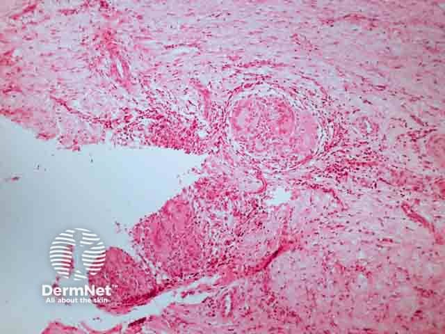 Гранулематозное воспаление и гигантские клетки в биоптате при инфекции Mycobacterium marinum