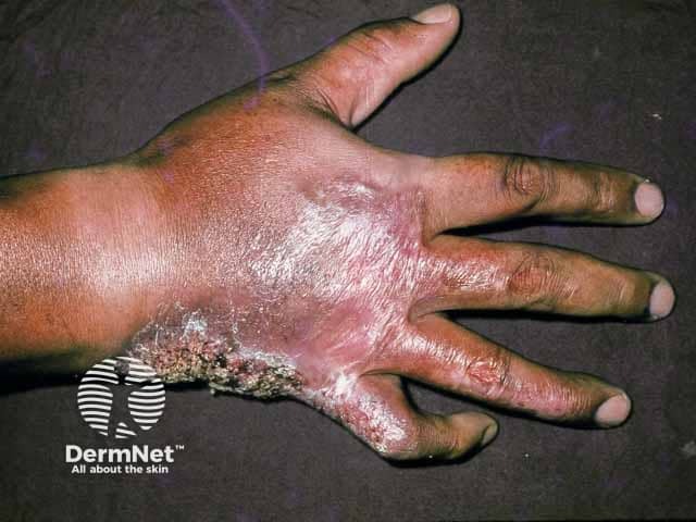 Распространенная инфекция Mycobacterium marinum кисти