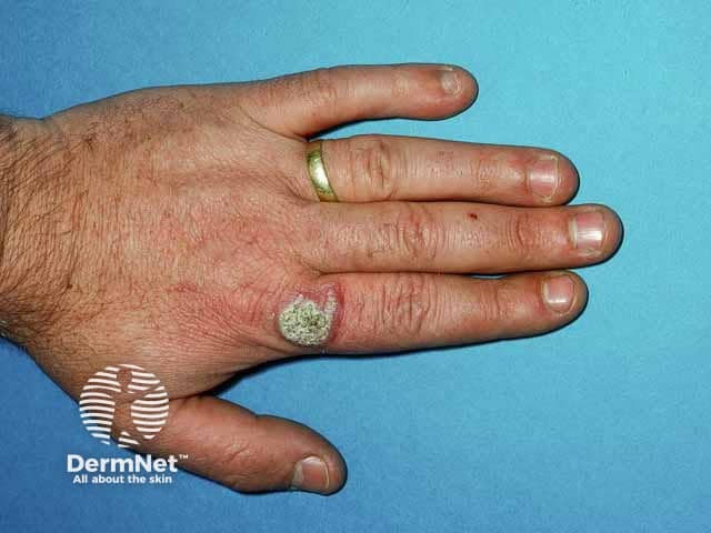 Веррукозная форма инфекции Mycobacterium marinum