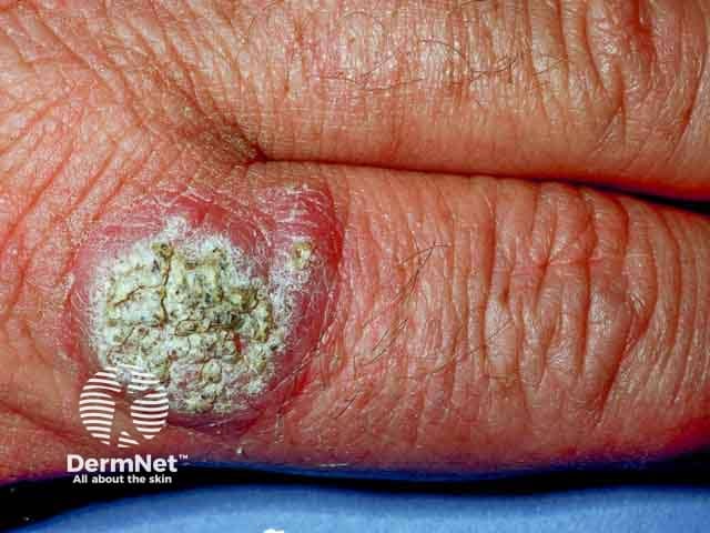 Веррукозная форма инфекции Mycobacterium marinum