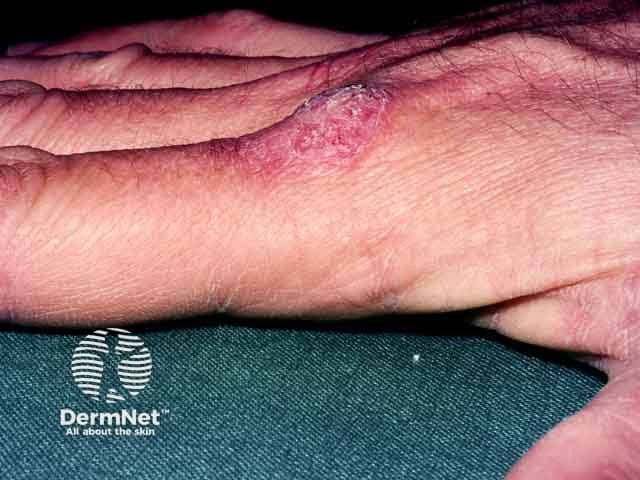 Веррукозная форма инфекции Mycobacterium marinum