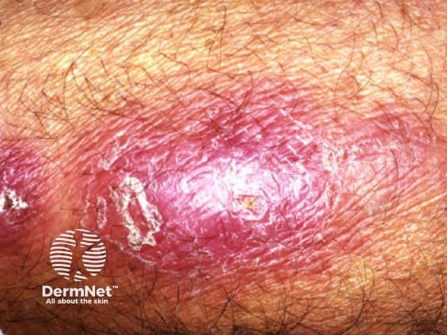 Инфекция Mycobacterium marinum