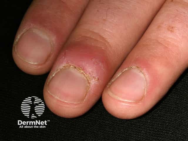 Инфекция Mycobacterium marinum