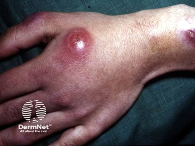 Инфекция Mycobacterium marinum