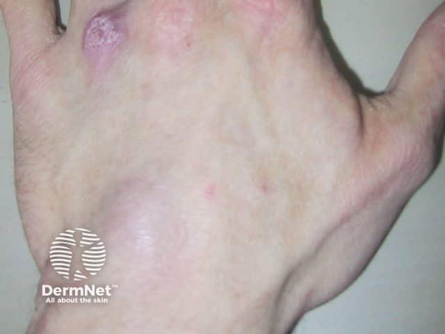 Инфекция Mycobacterium marinum